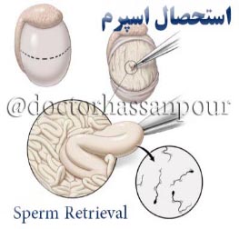 استحصال اسپرم (Sperm Retrieval)