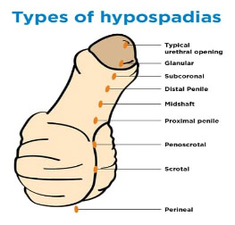 هیپوسپادیاز ( Hypospadias ) یا ختنه مادرزادی